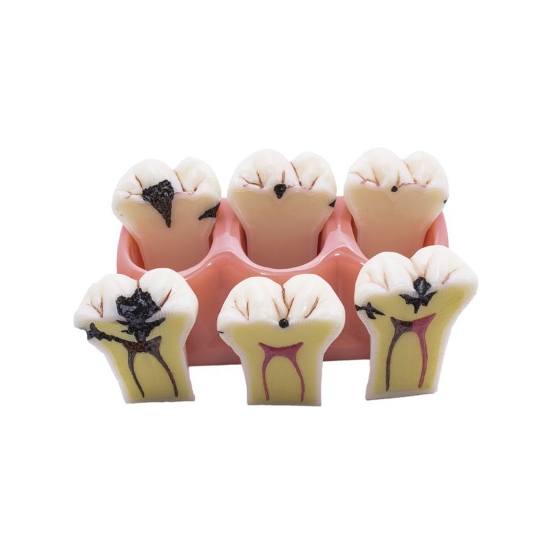 Modelo desmontable caries-1