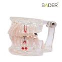 Modelo dental transparente con implante-0