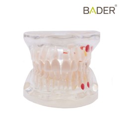Modelo dental transparente caries
