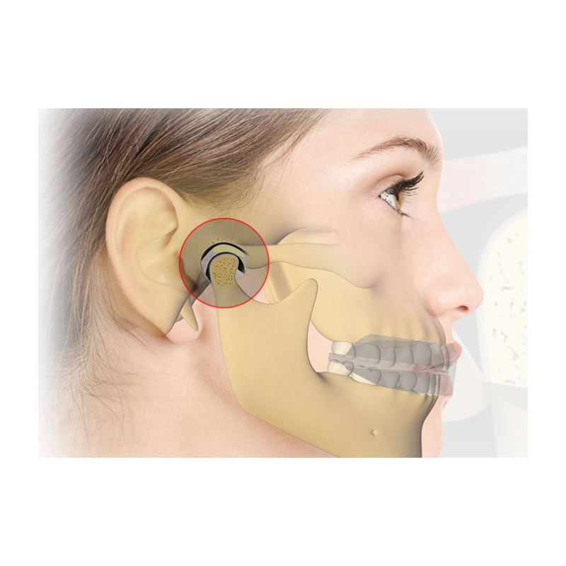 Myosa TMJ-4