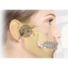 Myosa TMJ-4