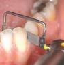 Orthostrip-1s-3-94x95.jpg